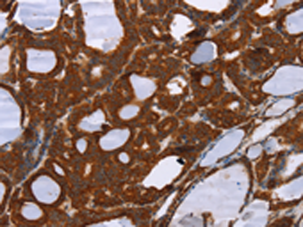 Immunohistochemistry of paraffin-embedded Human thyroid cancer tissue using TA364934 (PPP2R3C Antibody) at dilution 1/30 (Original magnification: x200)