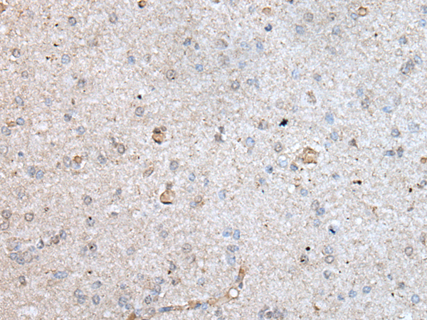 Formalin-Fixed, Paraffin-Embedded Human skin stained with Involucrin Antibody Clone SY5 using peroxidase conj ugate and DAB chromogen. Note cytoplasmic staining in the epidermal region.