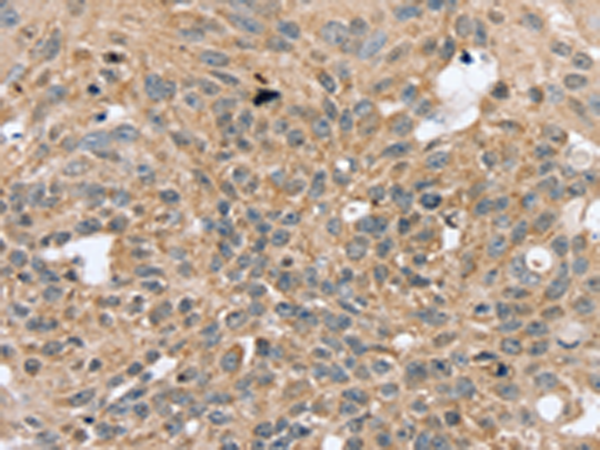 Formalin-Paraffin Human fetal liver stained with AFP Antibody (Clone C3).
