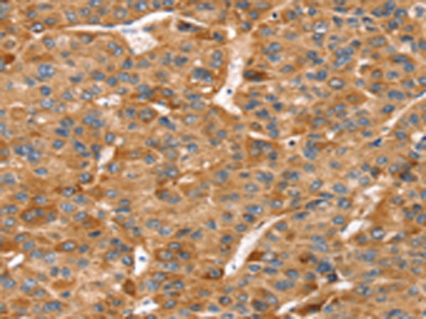 Immunohistochemistry of paraffin-embedded Human liver cancer tissue using TA364968 (RFFL Antibody) at dilution 1/20 (Original magnification: x200)