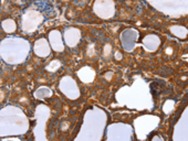 Immunohistochemistry of paraffin-embedded Human thyroid cancer tissue using TA364980 (RNF11 Antibody) at dilution 1/20 (Original magnification: x200)
