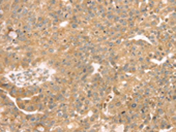 Immunohistochemistry of paraffin-embedded Human breast cancer tissue using TA364996 (SAMD3 Antibody) at dilution 1/30 (Original magnification: x200)