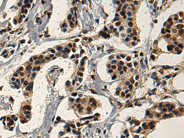 Immunohistochemistry of paraffin-embedded Human breast cancer tissue using TA365003 (SERTAD3 Antibody) at dilution 1/220 (Original magnification: x200)