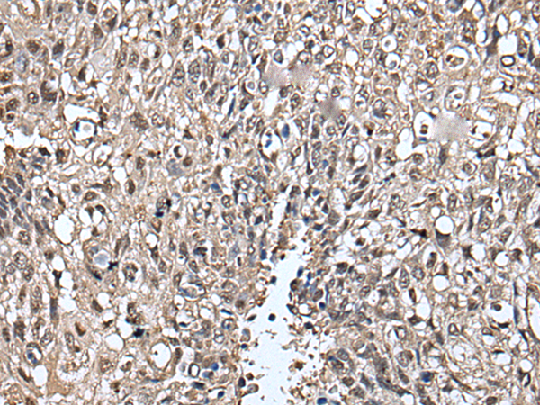 Immunohistochemistry of paraffin-embedded Human lung cancer tissue using TA365023 (SLITRK5 Antibody) at dilution 1/30 (Original magnification: x200)
