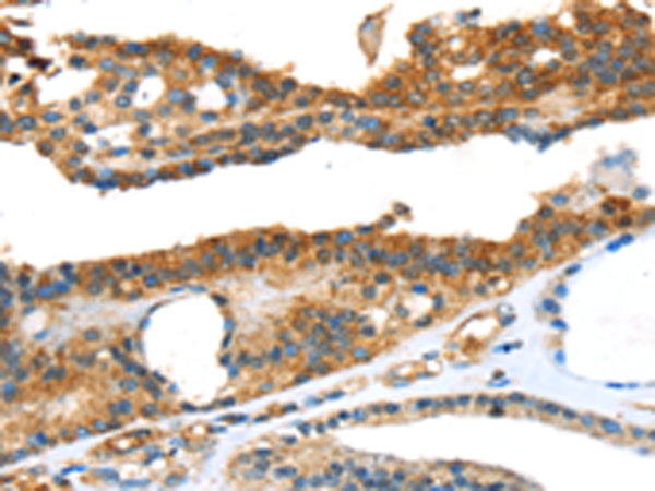 Immunohistochemistry of paraffin-embedded Human thyroid cancer tissue using TA365029 (SNAI3 Antibody) at dilution 1/20 (Original magnification: x200)