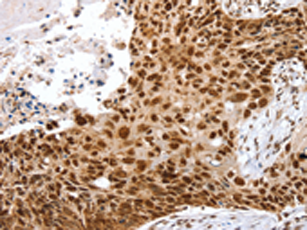 Immunohistochemistry of paraffin-embedded Human esophagus cancer tissue using TA365032 (SNX15 Antibody) at dilution 1/20 (Original magnification: x200)