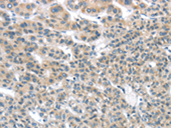 Immunohistochemistry of paraffin-embedded Human liver cancer tissue using TA365068 (THSD1 Antibody) at dilution 1/25 (Original magnification: x200)