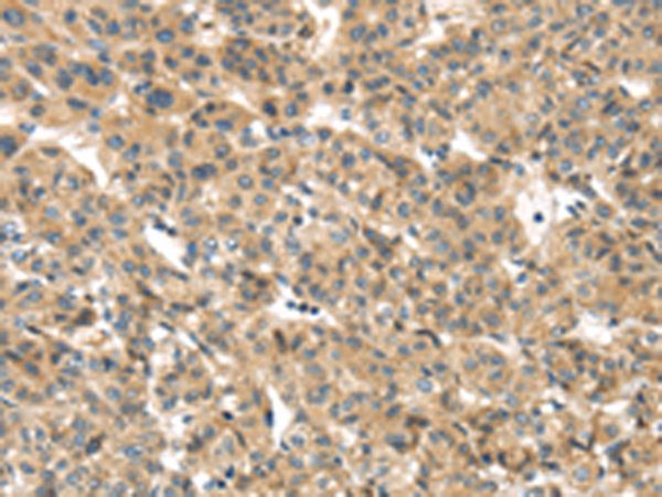 Immunohistochemistry of paraffin-embedded Human liver cancer tissue using TA365081 (TMEM161A Antibody) at dilution 1/30 (Original magnification: x200)