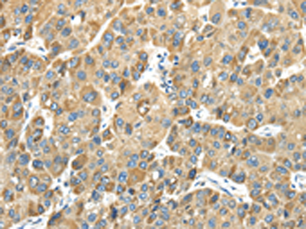 Immunohistochemistry of paraffin-embedded Human liver cancer tissue using TA365084 (TMPRSS11E Antibody) at dilution 1/30 (Original magnification: x200)