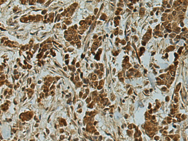 Immunohistochemistry of paraffin-embedded Human breast cancer tissue using TA365090 (TMEFF1 Antibody) at dilution 1/130 (Original magnification: x200)