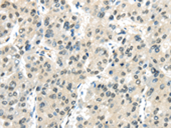 Immunohistochemistry of paraffin-embedded Human liver cancer tissue using TA365099 (MED18 Antibody) at dilution 1/20 (Original magnification: x200)