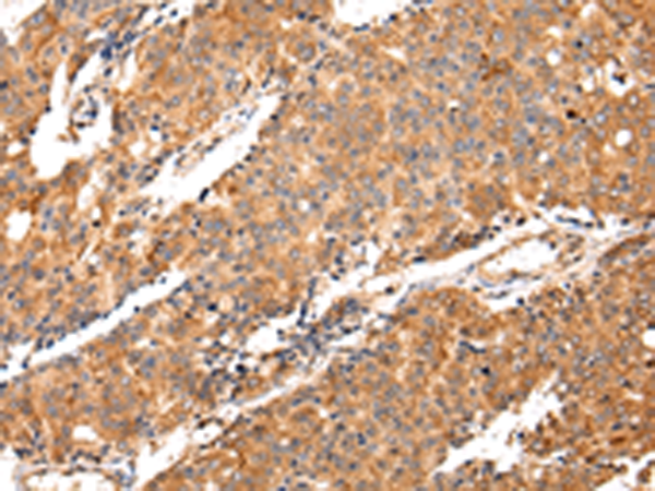 Representative Data Clone 45-15 (anti-IFN gamma) was analyzed by flow cytometry: Peripheral blood leucocytes were isolated from a blood sample obtained from a healthy volunteer and subsequently activated, fixed and permeabilized. Direct staining was performed using 10 ul of PE-conj ugated monoclonal antibody in combination with 10 ul of anti-CD45 FITC per sample.