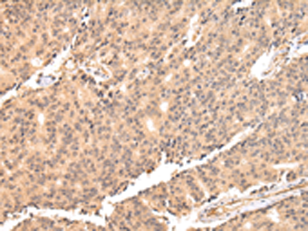 Immunohistochemistry of paraffin-embedded Human prostate cancer tissue using TA365127 (USP45 Antibody) at dilution 1/25 (Original magnification: x200)