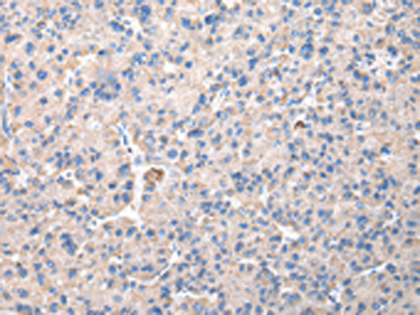Immunohistochemistry of paraffin-embedded Human liver cancer tissue using TA365136 (CHMP3 Antibody) at dilution 1/30 (Original magnification: x200)