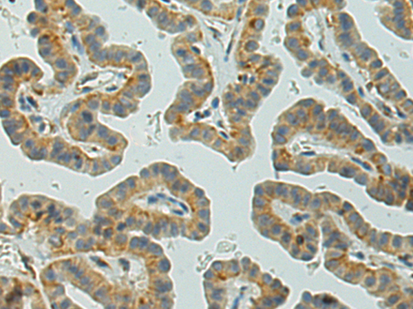 Immunohistochemistry of paraffin-embedded Human thyroid cancer tissue using TA365141 (VPS39 Antibody) at dilution 1/150 (Original magnification: x200)