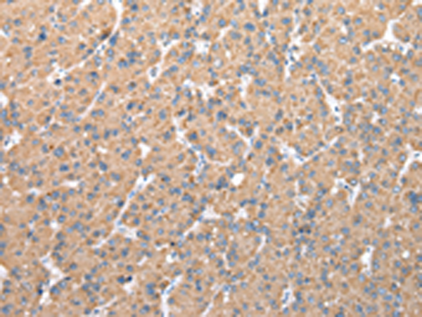 Immunohistochemistry of paraffin-embedded Human liver cancer tissue using TA365150 (CFAP52 Antibody) at dilution 1/20 (Original magnification: x200)