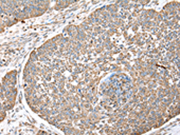 Immunohistochemistry of paraffin-embedded Human lung cancer tissue using TA365153 (DPH7 Antibody) at dilution 1/40 (Original magnification: x200)