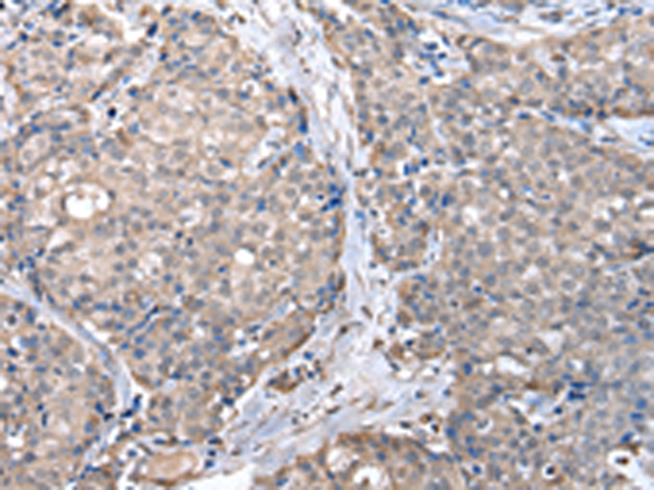 Immunohistochemistry of paraffin-embedded Human breast cancer tissue using TA365176 (ZFP2 Antibody) at dilution 1/20 (Original magnification: x200)