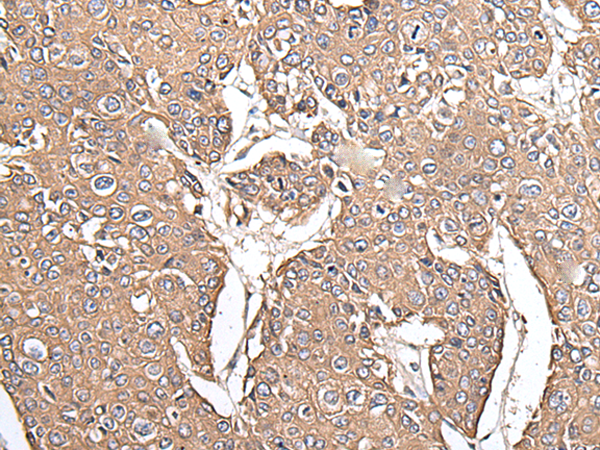 Immunohistochemistry of paraffin-embedded Human prostate cancer tissue using TA365183 (KRT73 Antibody) at dilution 1/55 (Original magnification: x200)