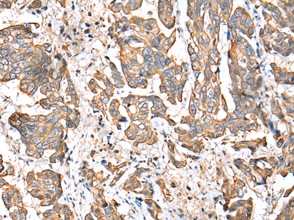 Immunohistochemistry of paraffin-embedded Human breast cancer tissue using TA365202 (RABL2B Antibody) at dilution 1/25 (Original magnification: x200)