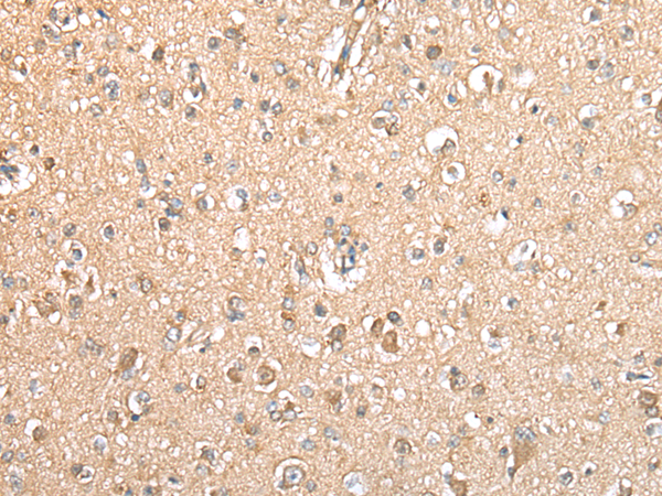Immunohistochemistry of paraffin-embedded Human brain tissue using TA365216 (TYROBP Antibody) at dilution 1/20 (Original magnification: x200)