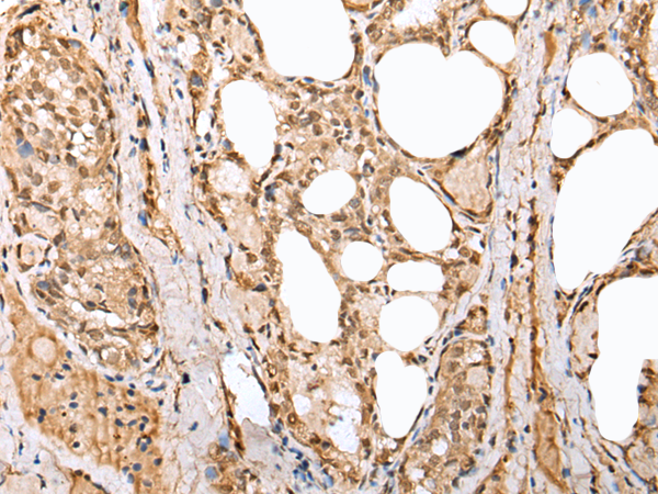 Immunohistochemistry of paraffin-embedded Human thyroid cancer tissue using TA365223 (PHTF2 Antibody) at dilution 1/35 (Original magnification: x200)