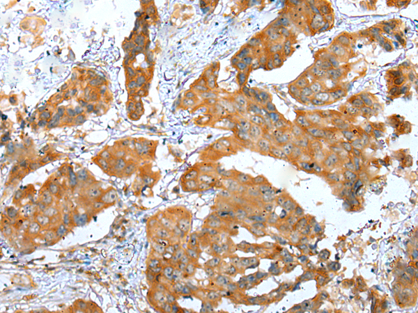 Immunohistochemistry of paraffin-embedded Human breast cancer tissue using TA365225 (ERMP1 Antibody) at dilution 1/30 (Original magnification: x200)