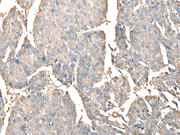 Immunohistochemistry of paraffin-embedded Human liver cancer tissue using TA365245 (PRSS38 Antibody) at dilution 1/30 (Original magnification: x200)