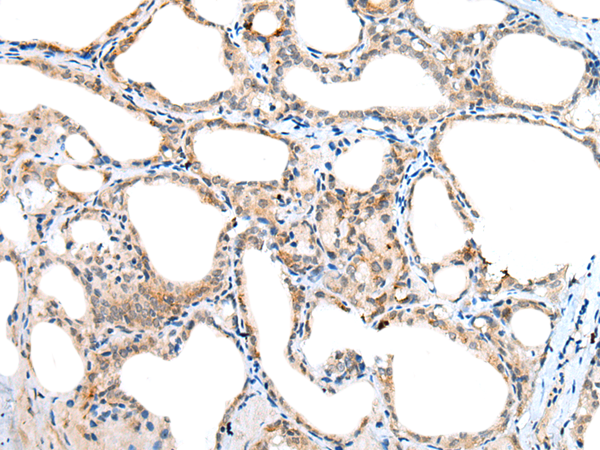 Immunohistochemistry of paraffin-embedded Human thyroid cancer tissue using TA365270 (NUDT6 Antibody) at dilution 1/30 (Original magnification: x200)