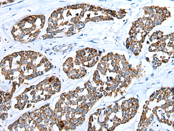 Immunohistochemistry of paraffin-embedded Human esophagus cancer tissue using TA365276 (RHOV Antibody) at dilution 1/25 (Original magnification: x200)