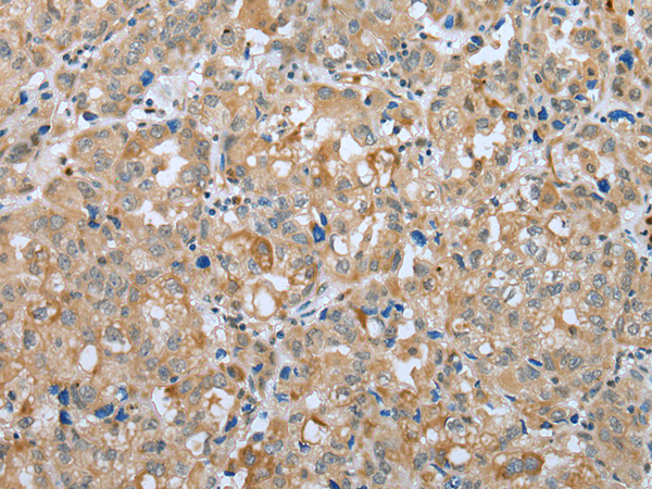Immunohistochemistry of paraffin-embedded Human ovarian cancer tissue using TA365316 (PLA2G4D Antibody) at dilution 1/25 (Original magnification: x200)