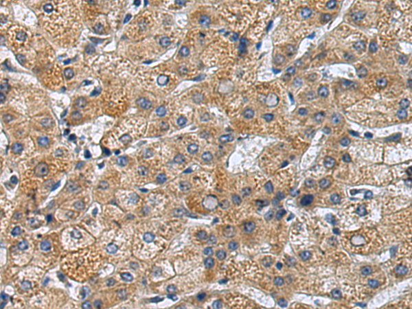 Formalin-Paraffin Human melanoma stained with MART-1 Antibody (Clone SPM342).