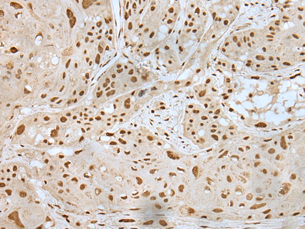 Immunohistochemistry of paraffin-embedded Human esophagus cancer tissue using TA365381 (ZNF19 Antibody) at dilution 1/35 (Original magnification: x200)