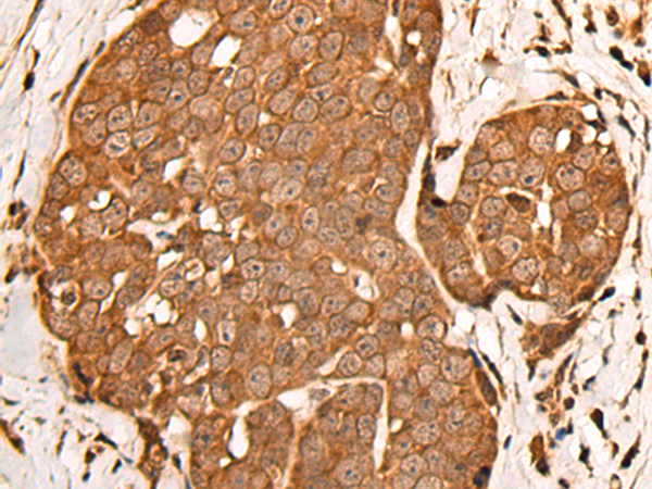 Immunohistochemistry of paraffin-embedded Human thyroid cancer tissue using TA365387 (ZPR1 Antibody) at dilution 1/30 (Original magnification: x200)