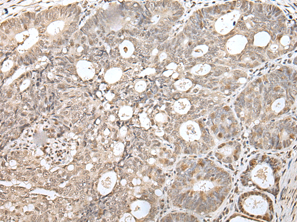Immunohistochemistry of paraffin-embedded Human gastric cancer tissue using TA365389 (ZNF266 Antibody) at dilution 1/30 (Original magnification: x200)