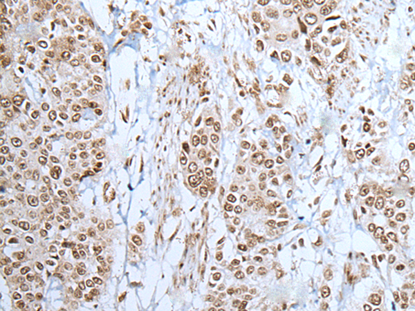 Formalin Paraffin rhabdomyosarcoma stained with Myogenin Antibody (Clone SPM144).