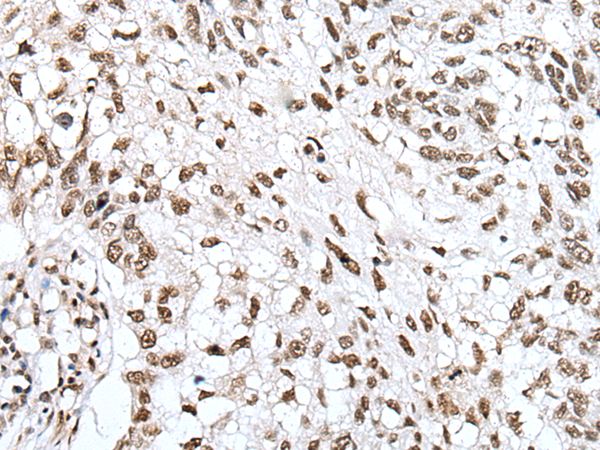 Immunohistochemistry of paraffin-embedded Human lung cancer tissue using TA365400 (ZNF43 Antibody) at dilution 1/30 (Original magnification: x200)