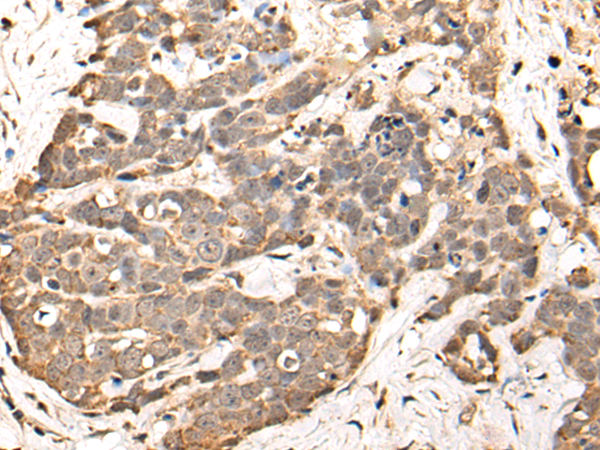 Immunohistochemistry of paraffin-embedded Human thyroid cancer tissue using TA365431 (WDFY3 Antibody) at dilution 1/30 (Original magnification: x200)