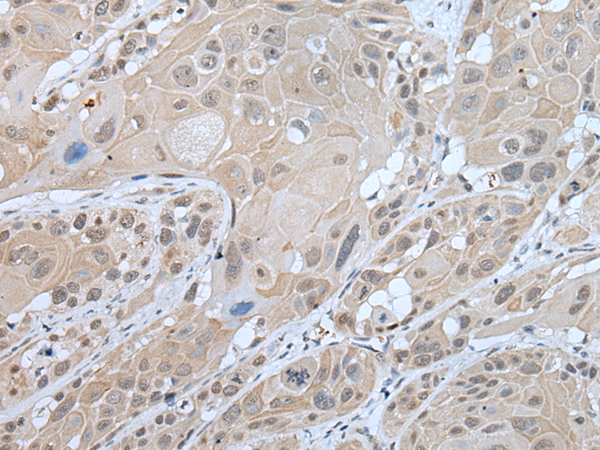 Formalin-paraffin leiomyosarcoma stained with Smooth Muscle Actin Antibody (Clone SPM332).