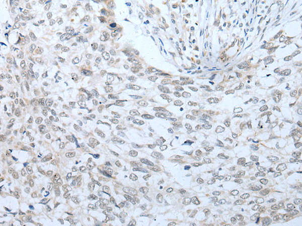 Immunohistochemistry of paraffin-embedded Human lung cancer tissue using TA365444 (VNN2 Antibody) at dilution 1/30 (Original magnification: x200)