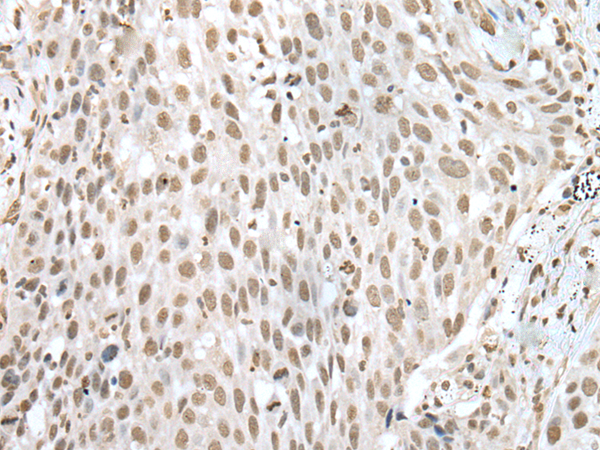 <p>Formalin-paraffin human Testic ular Carcinoma Stained with TGF alpha MAb (SPM542)