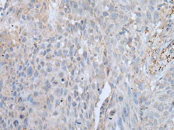 Immunohistochemistry of paraffin-embedded Human lung cancer tissue using TA365451 (VWA2 Antibody) at dilution 1/45 (Original magnification: x200)