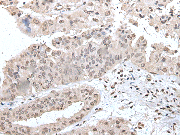 Formalin-paraffin human melanoma stained with Vimentin Antibody (Clone SPM576).