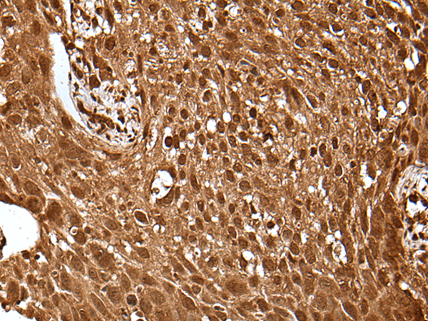 Formalin-paraffin human melanoma stained with Vimentin Antibody (Clone SPM576).