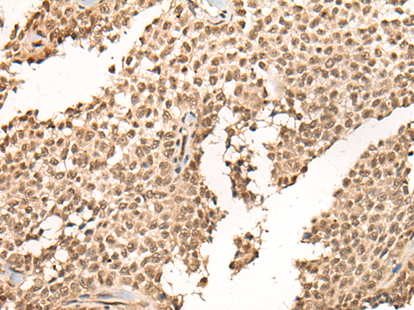 Immunohistochemistry of paraffin-embedded Human ovarian cancer tissue using TA365514 (BCL6B Antibody) at dilution 1/30 (Original magnification: x200)