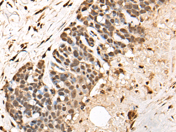 Immunohistochemistry of paraffin-embedded Human thyroid cancer tissue using TA365515 (BCL9 Antibody) at dilution 1/30 (Original magnification: x200)