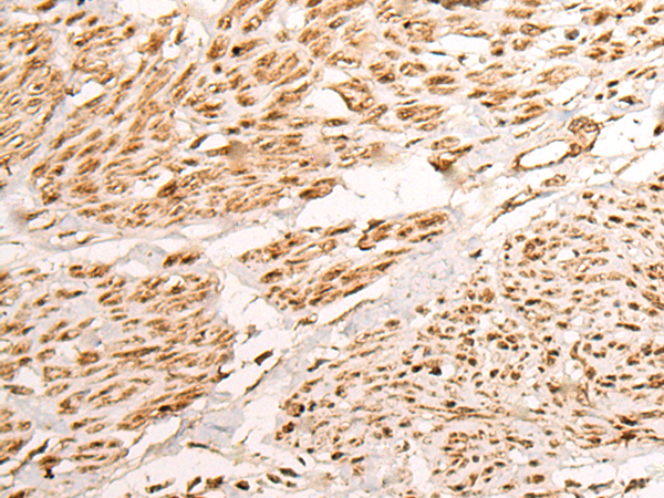 Immunohistochemistry of paraffin-embedded Human cervical cancer tissue using TA365533 (NCAPH Antibody) at dilution 1/35 (Original magnification: x200)