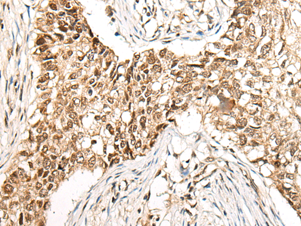 Immunohistochemistry of paraffin-embedded Human lung cancer tissue using TA365551 (CCDC181 Antibody) at dilution 1/50 (Original magnification: x200)
