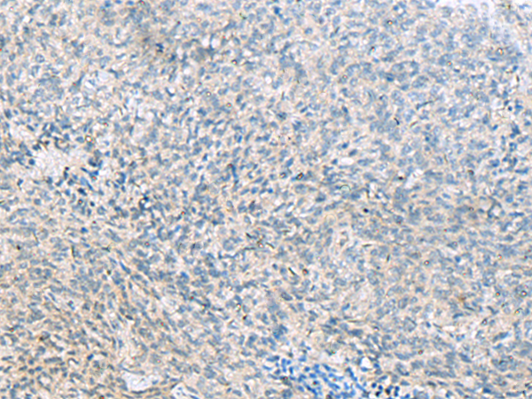Immunohistochemistry of paraffin-embedded Human cervical cancer tissue using TA365552 (C1orf112 Antibody) at dilution 1/55 (Original magnification: x200)