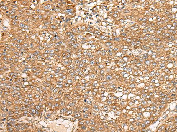 Immunohistochemistry of paraffin-embedded Human liver cancer tissue using TA365558 (EDEM2 Antibody) at dilution 1/30 (Original magnification: x200)
